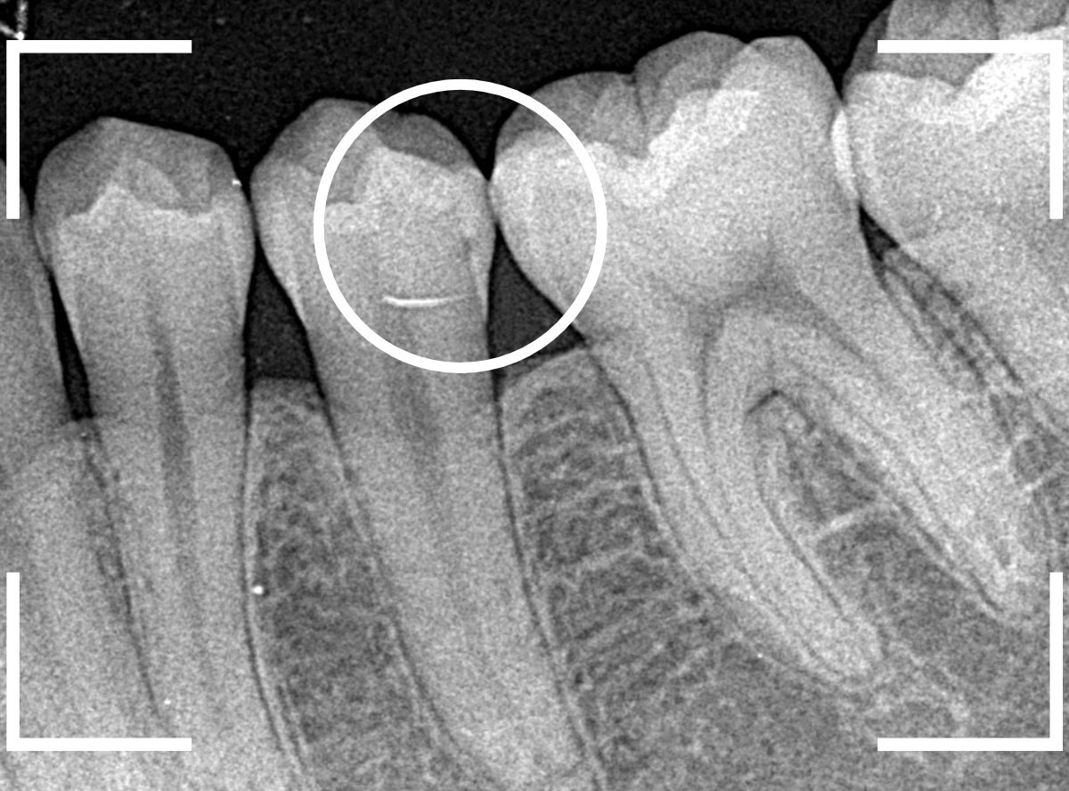 セラミック治療(インレー)23-2