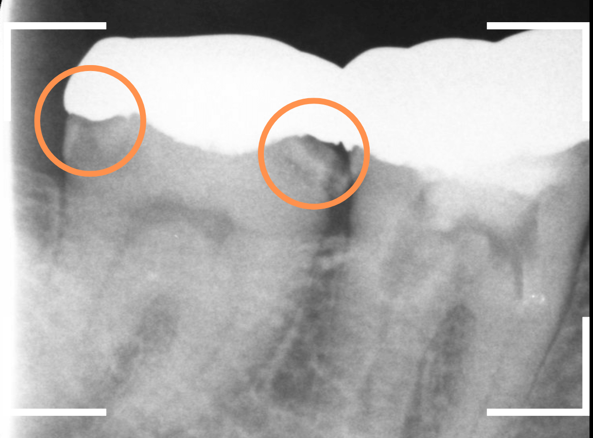 気づかないうちに深い虫歯14-2