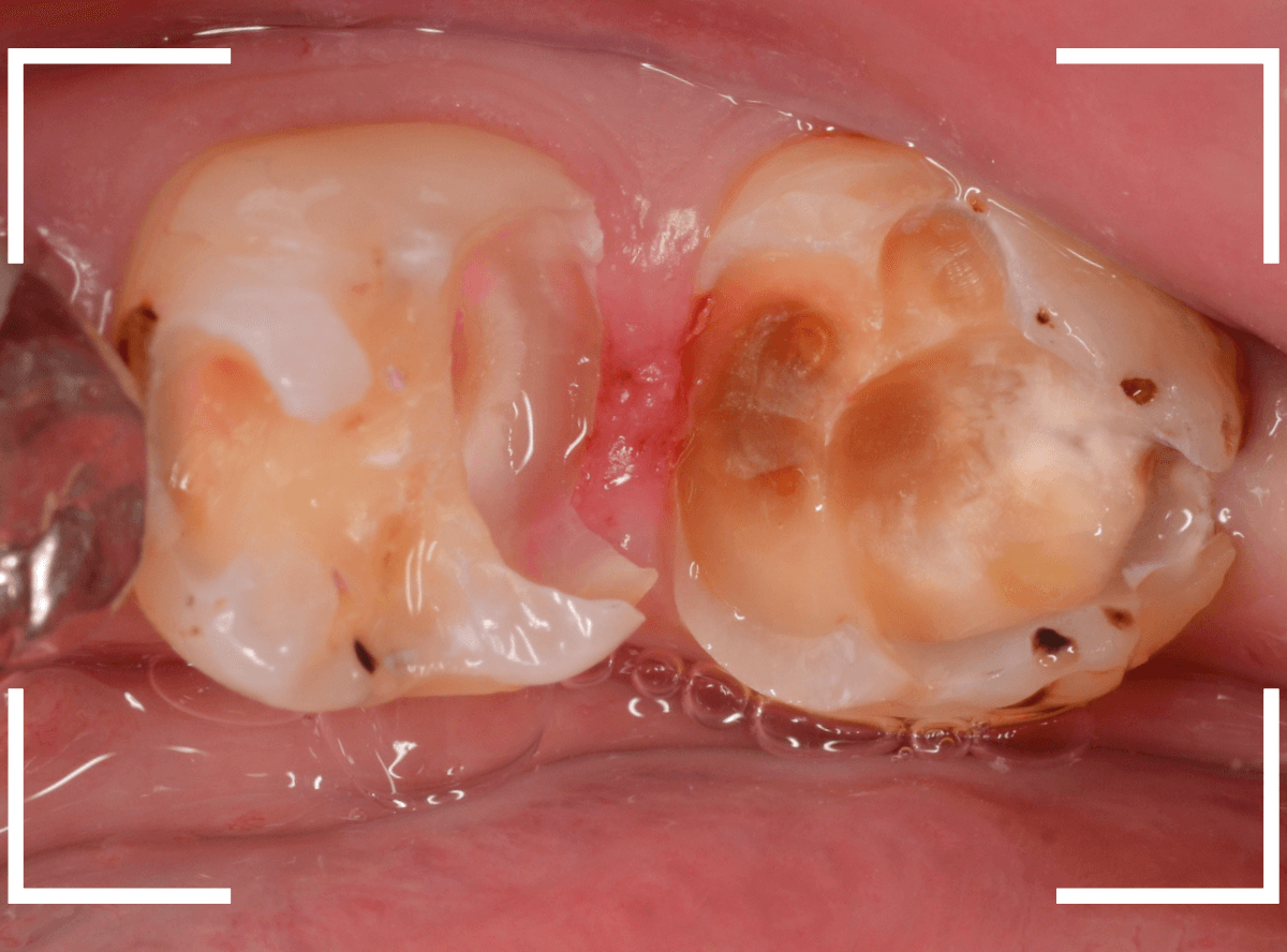 つめものの下の深い虫歯(画像)10-1