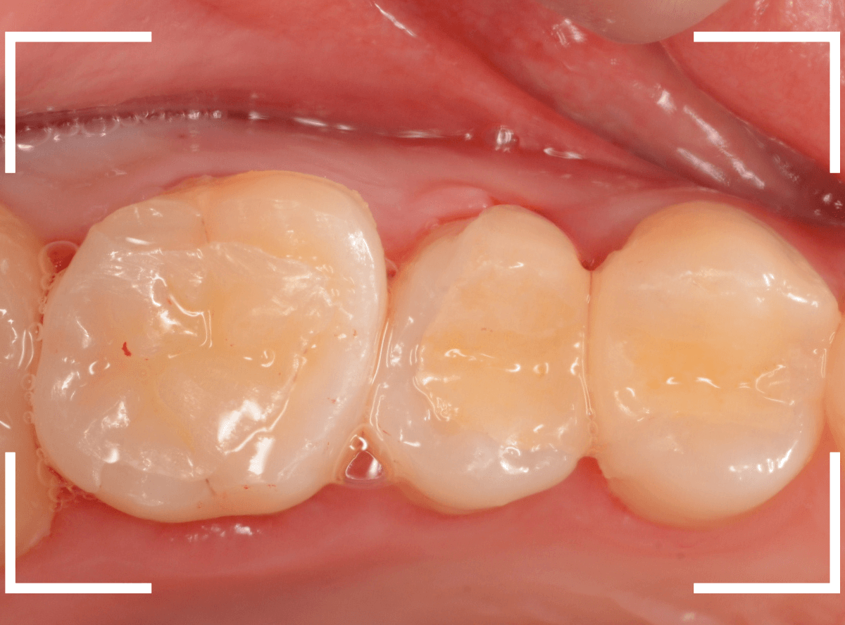 セラミック治療(インレー)32-12