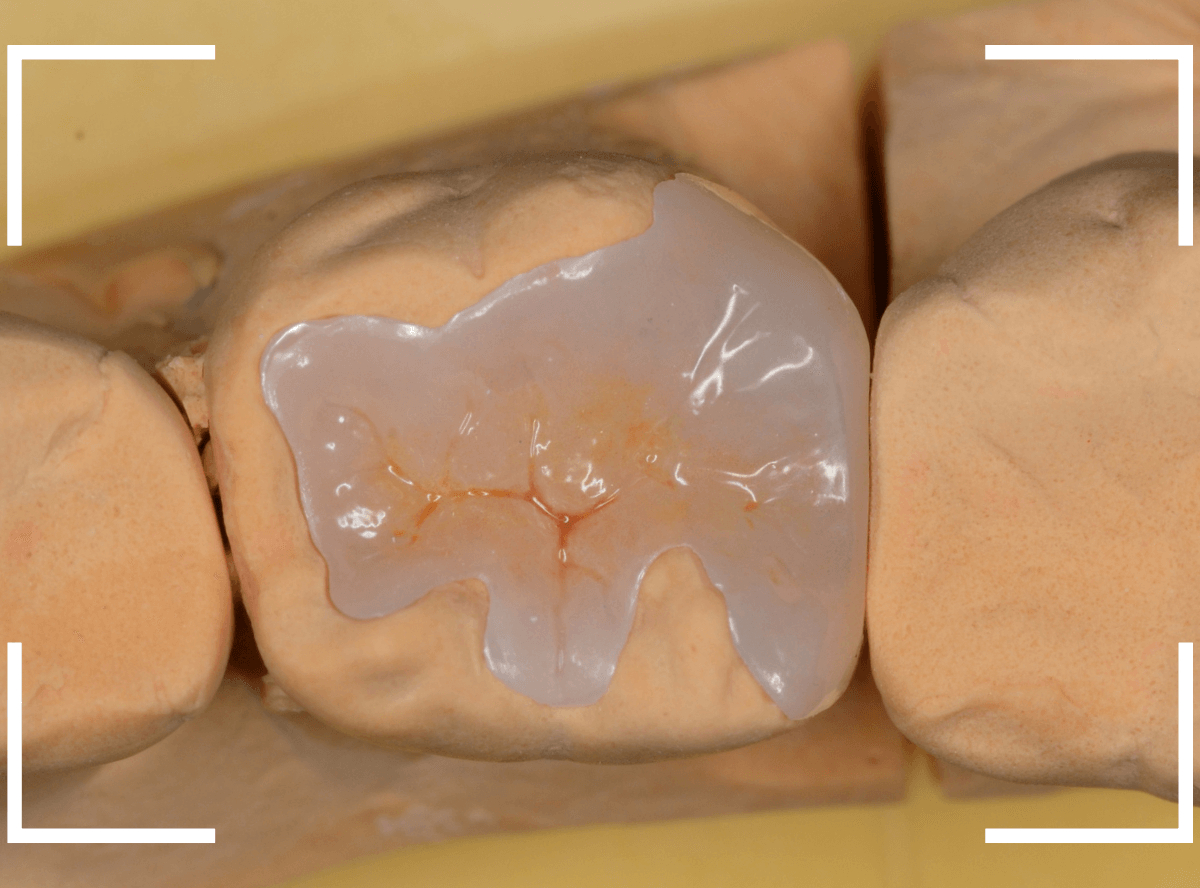 セラミック治療(インレー)17-5