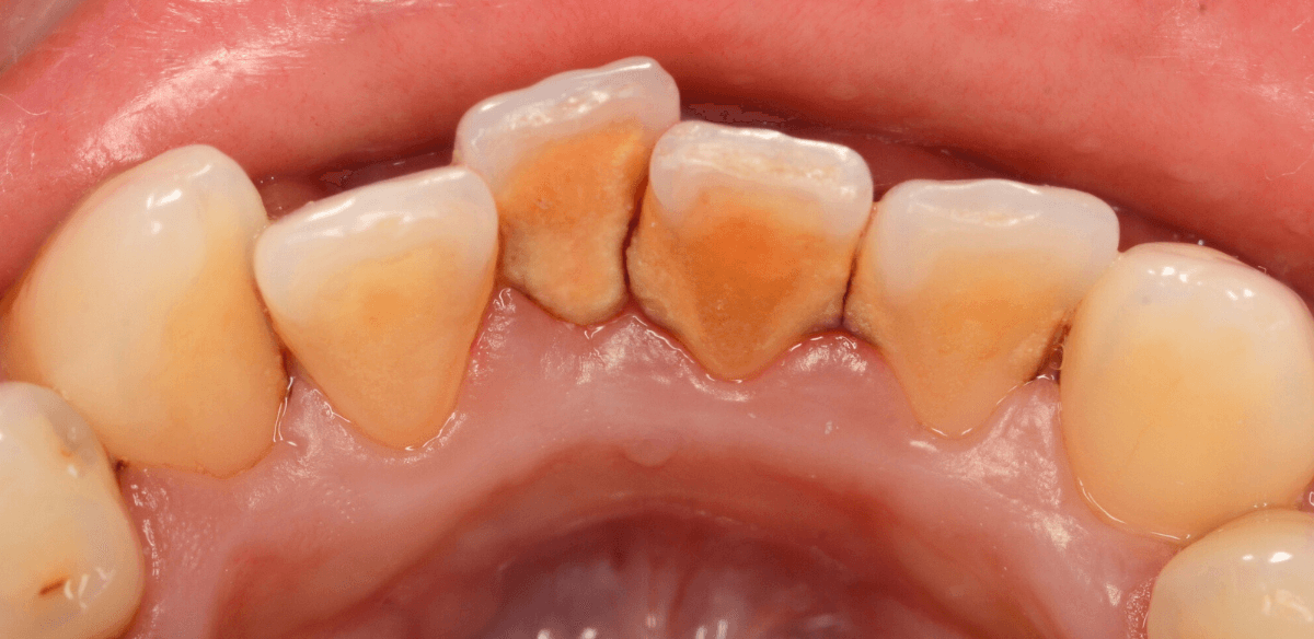 歯肉の中の歯石（歯肉縁下歯石）除去(画像）4-1