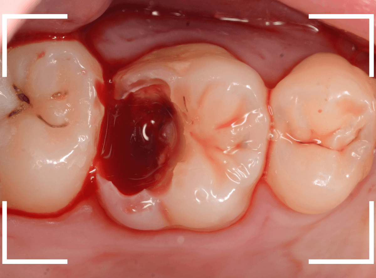 つめものの下の深い深い虫歯20-1