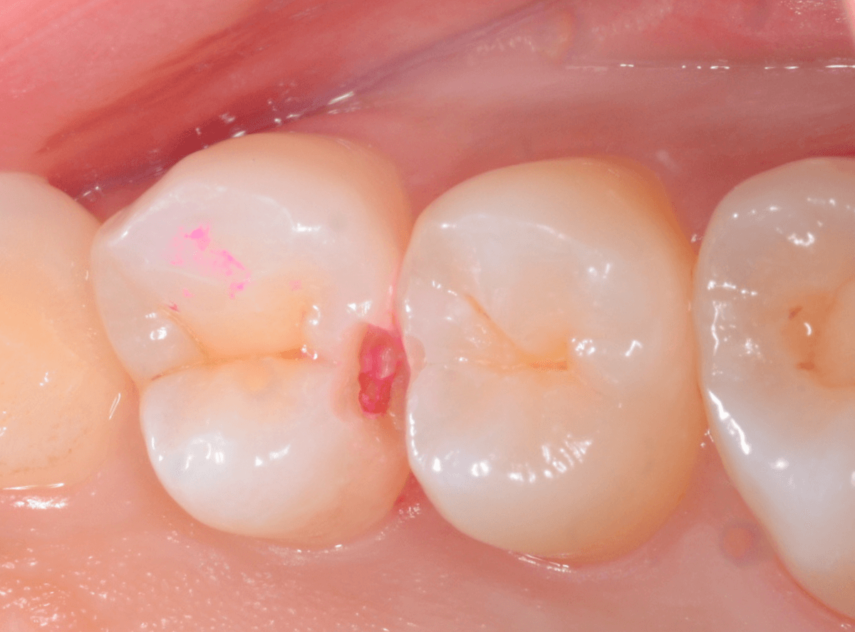 他の歯医者さんで虫歯と言われなかった虫歯の話(画像)4