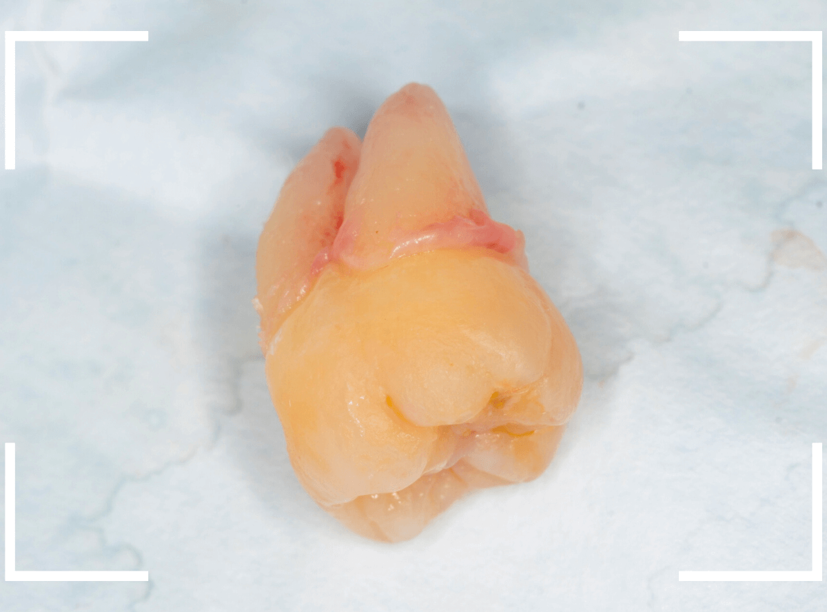 おやしらずの抜歯14-3