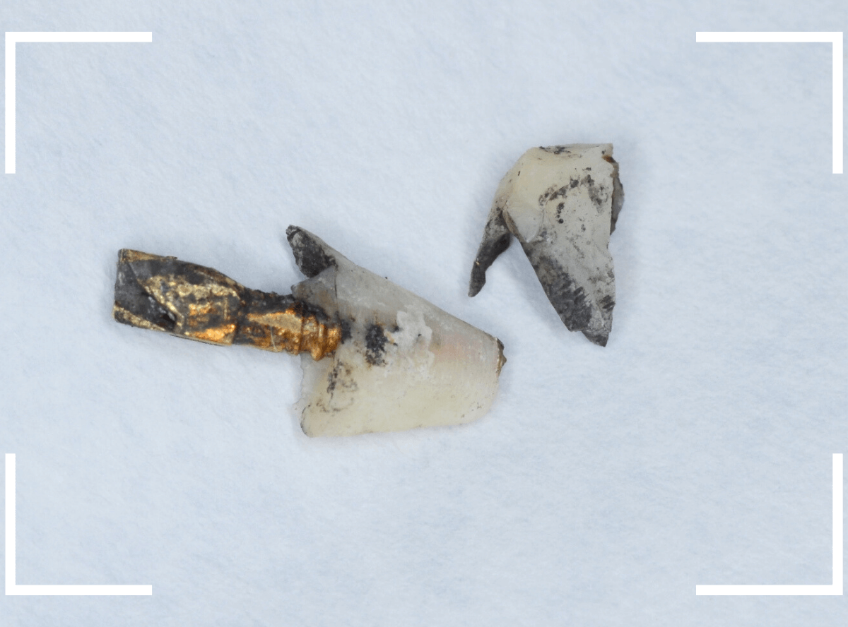 セラミック治療(クラウン・奥歯)8-3