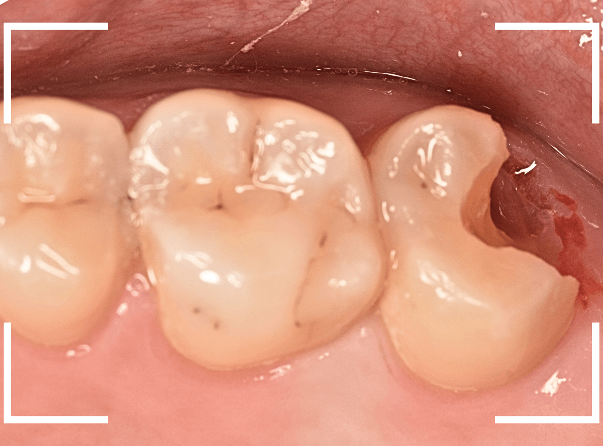 気づかないうちに深い虫歯5-4