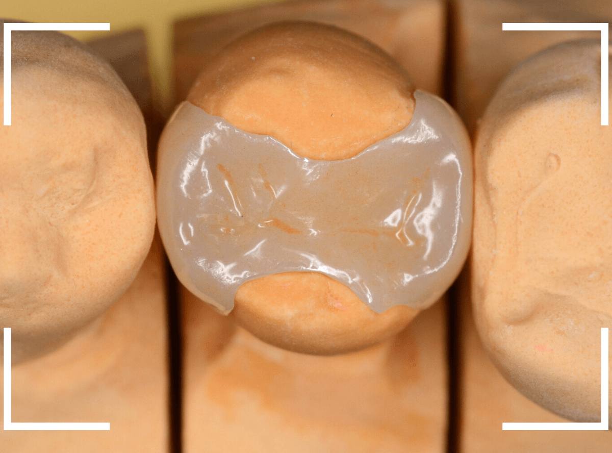 セラミック治療(インレー)25-3