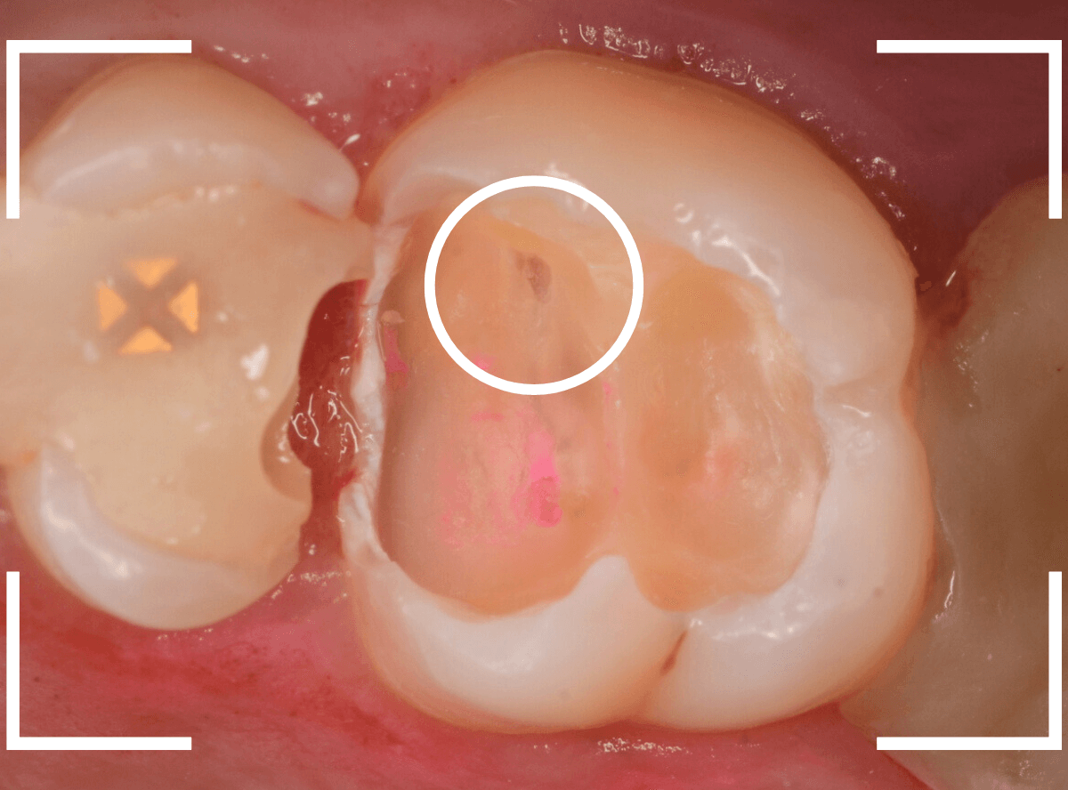 つめものの下の深い深い虫歯20-4