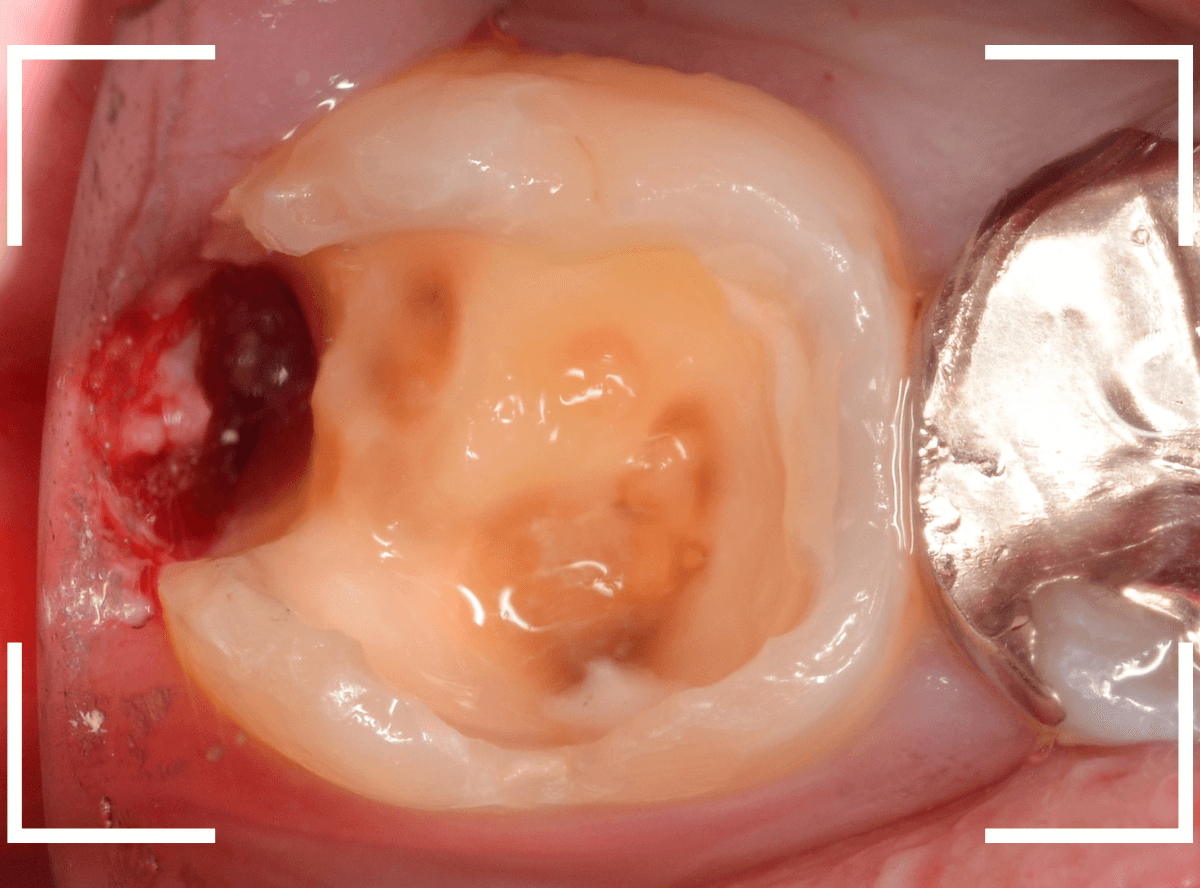 気づかないうちに深い虫歯13-5