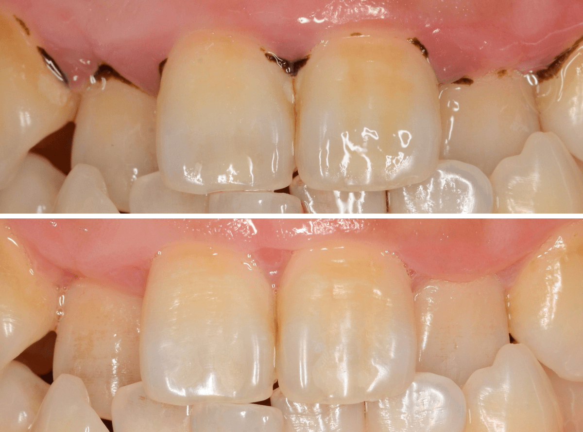 歯肉の中の歯石（歯肉縁下歯石）除去(画像）4-5
