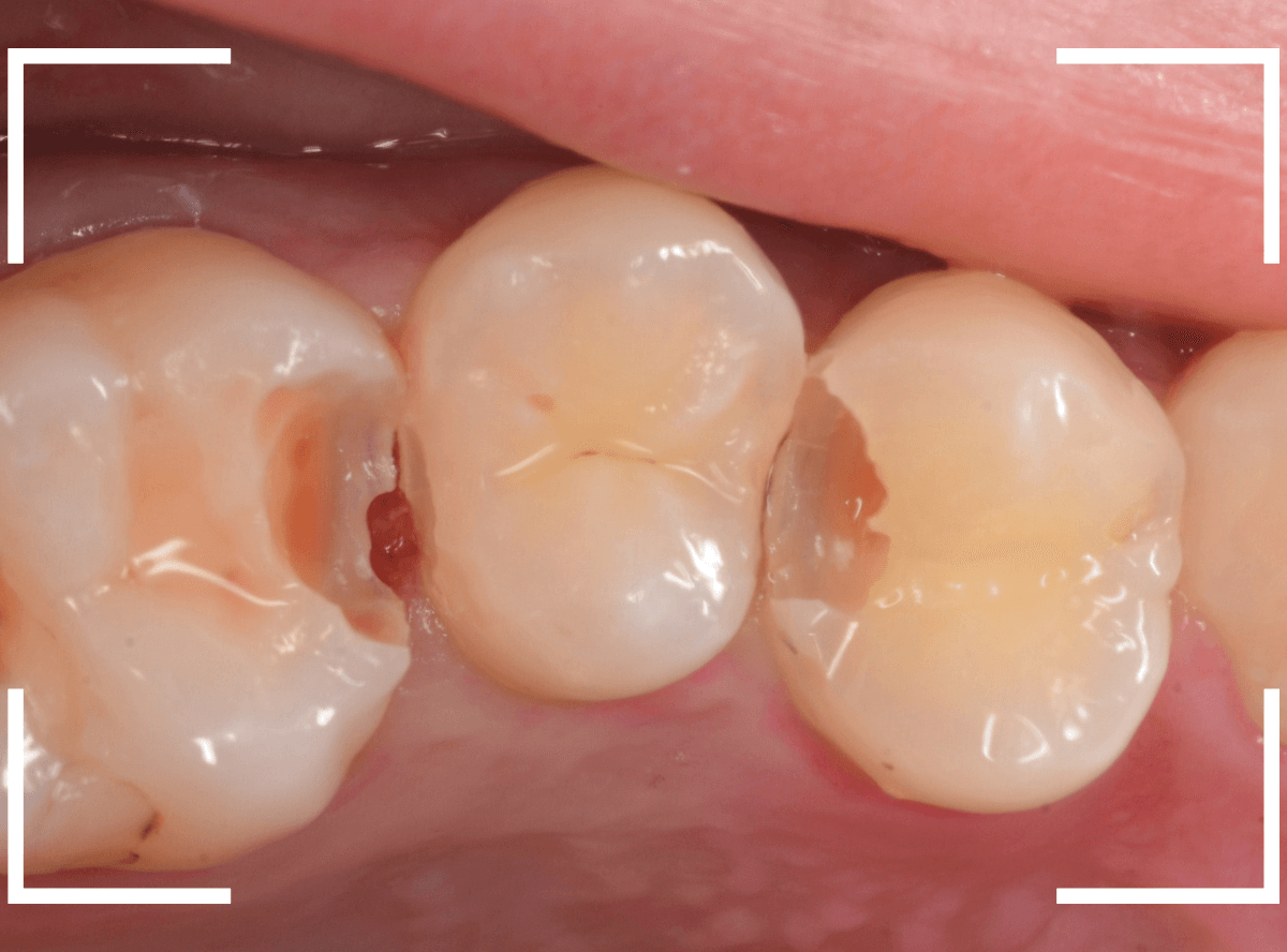 歯と歯の間の虫歯17-5