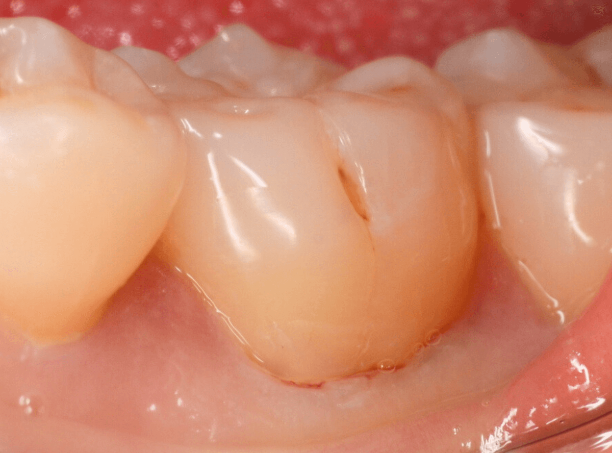 知覚過敏の画像5-4