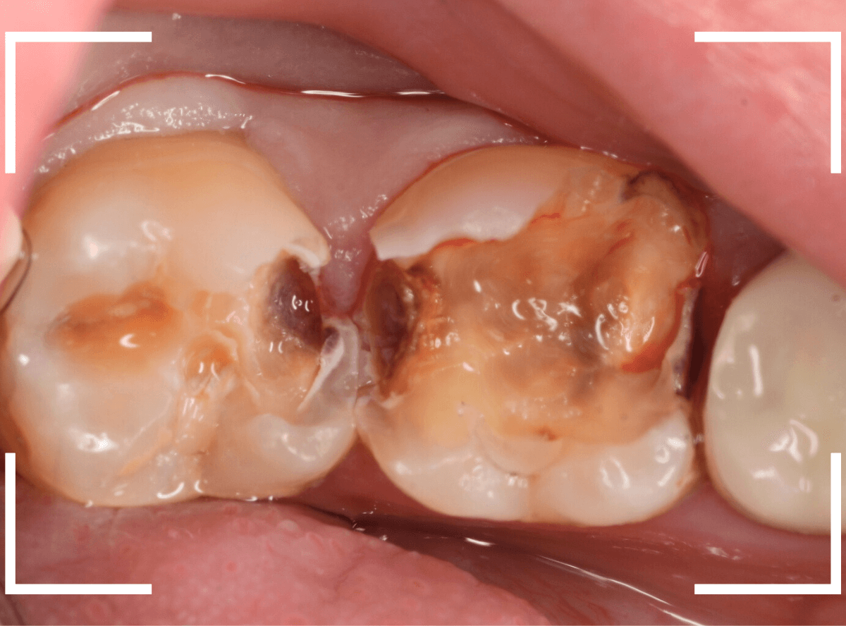 歯と歯の間の虫歯18-4