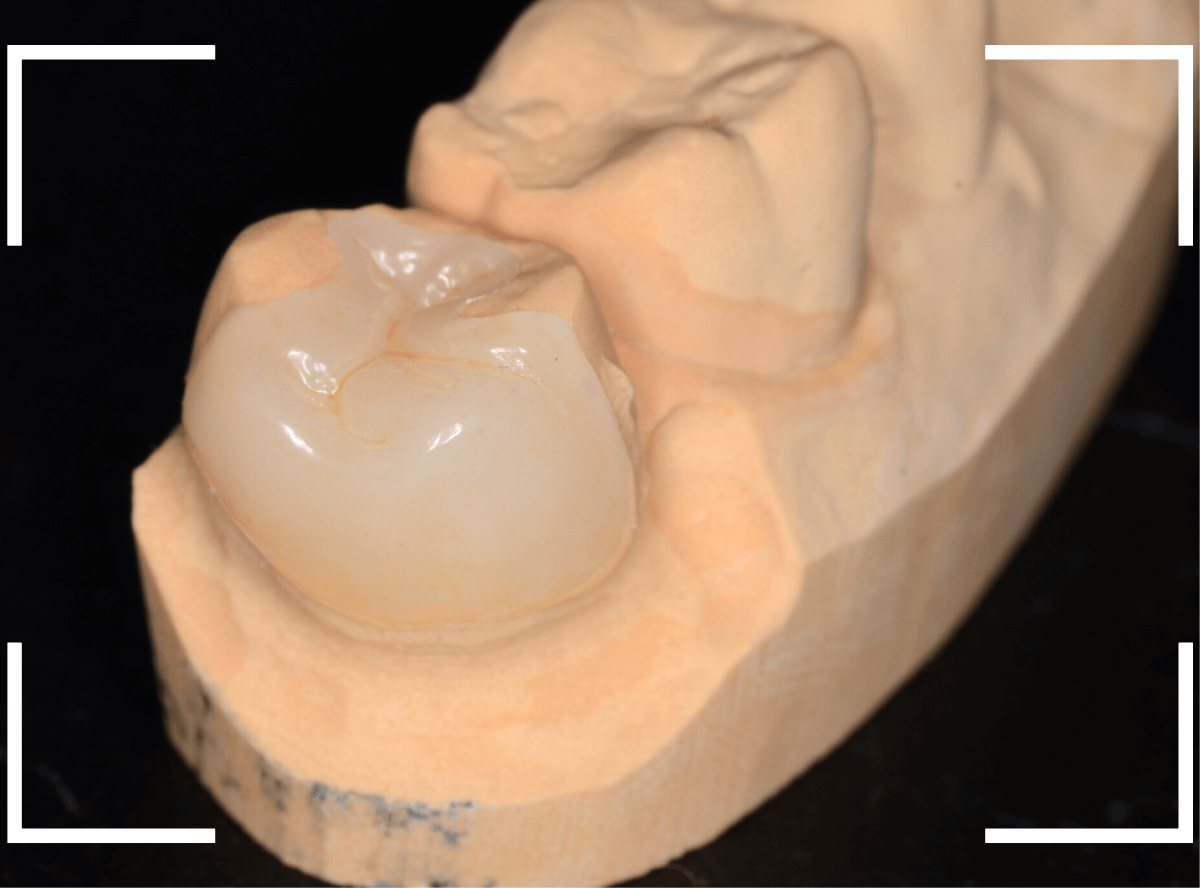 気づかないうちに深い虫歯3-8