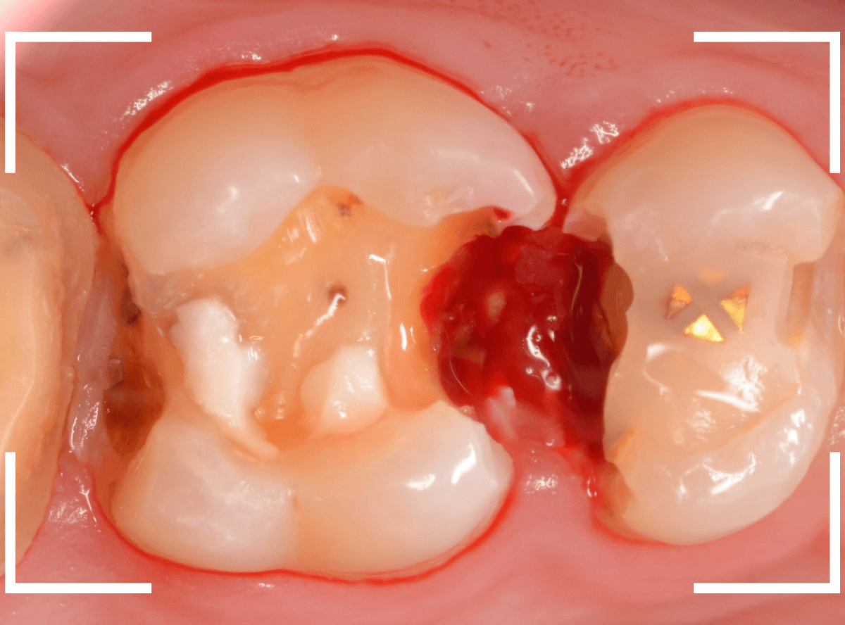 気づかないうちに深い虫歯7-3