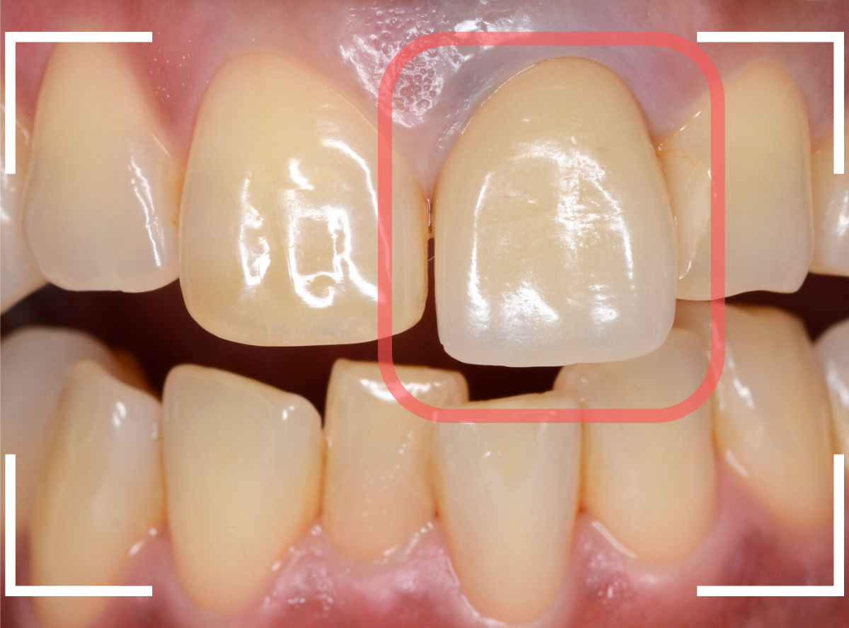セラミック治療(前歯・クラウン)3-1