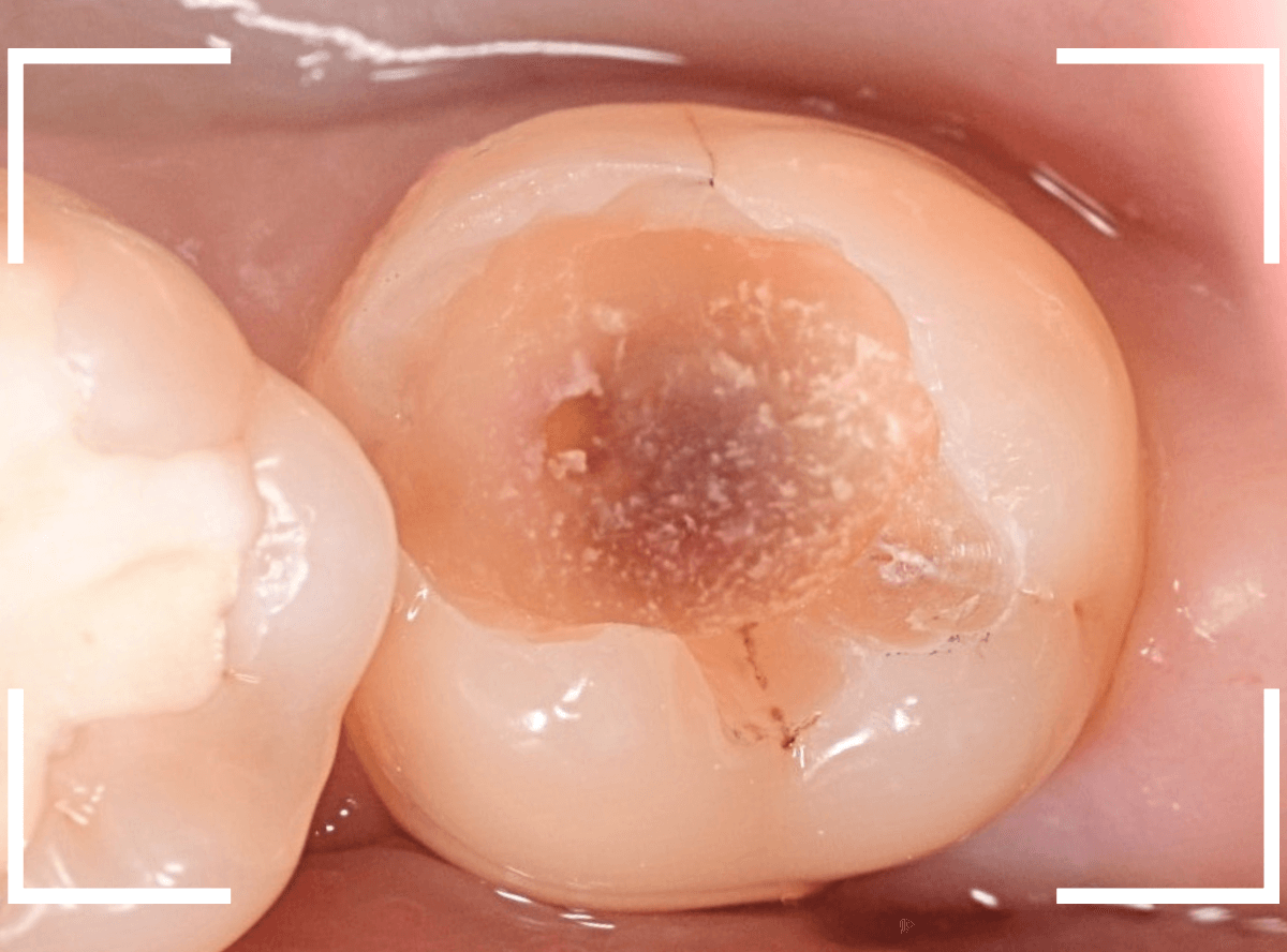 つめものの下の深い深い虫歯20-1