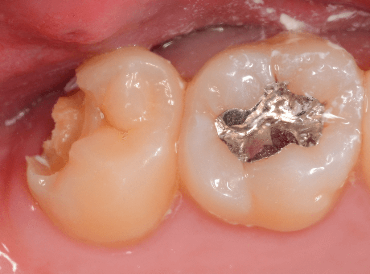 気づかないうちに深い虫歯1-4