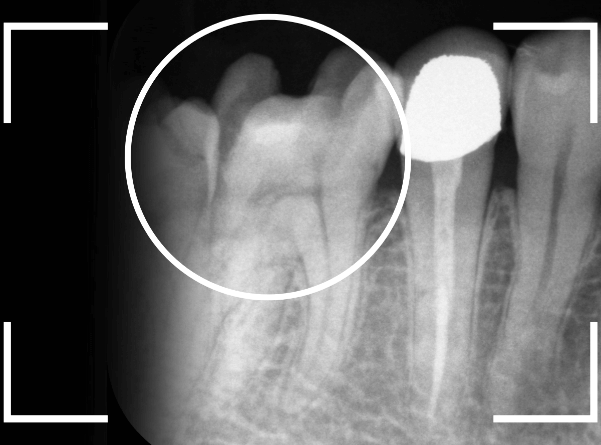レントゲンでわかりづらい虫歯19-2