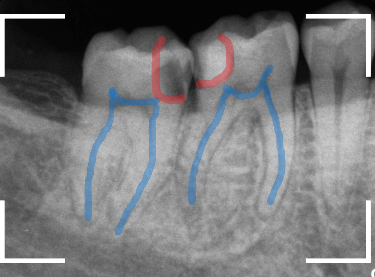 歯と歯の間の虫歯23-2