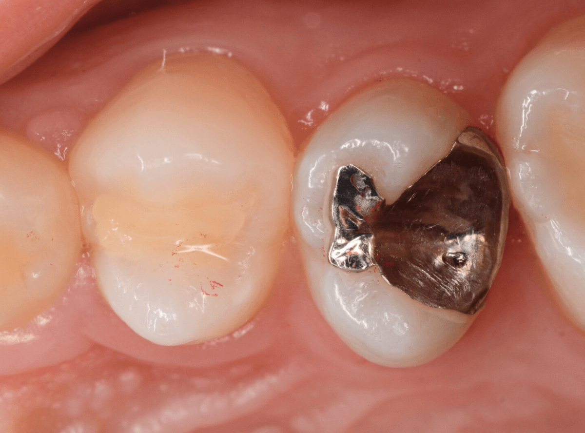 つめものの下の深い深い虫歯11-1