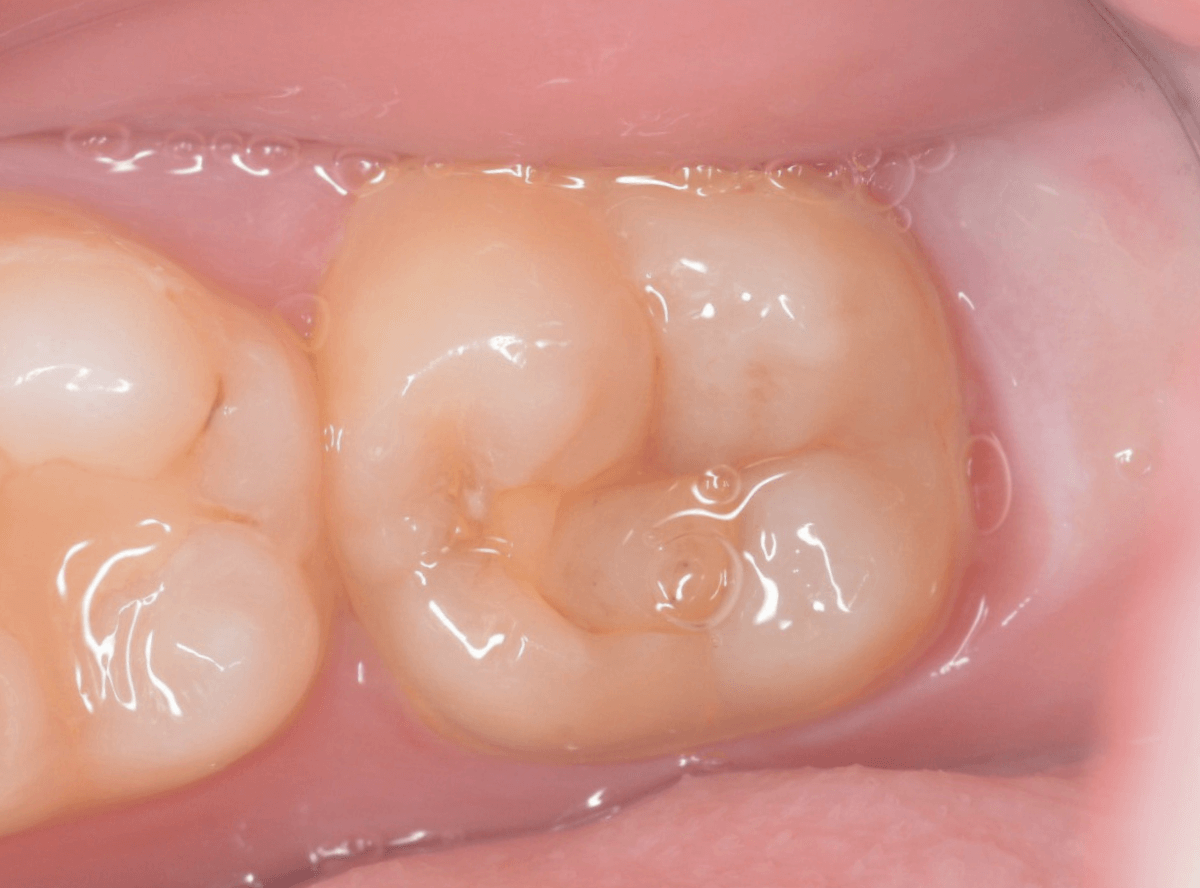 つめものの下の深い虫歯(画像)2-1
