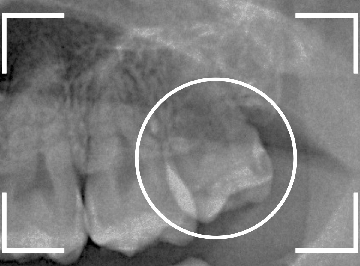 おやしらずの抜歯16-2