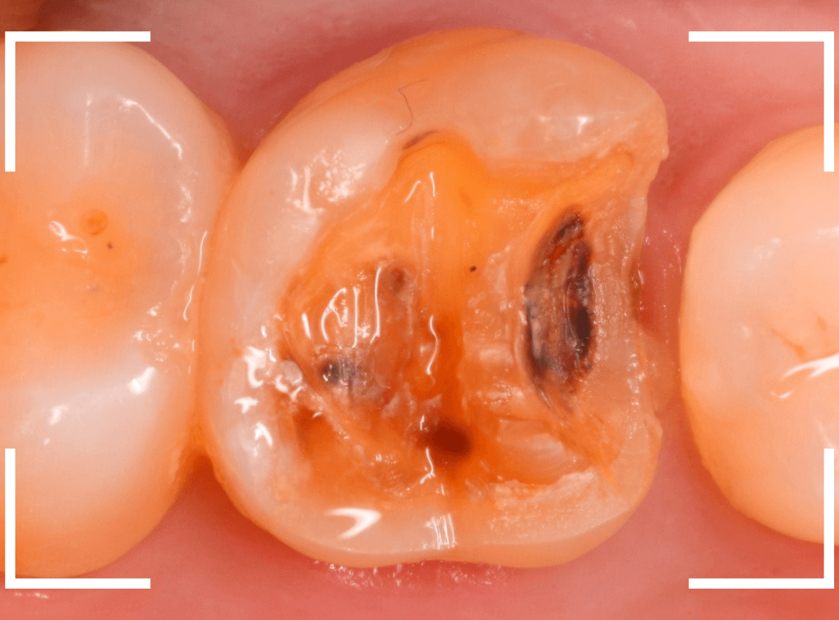 セラミック治療(インレー)19-2