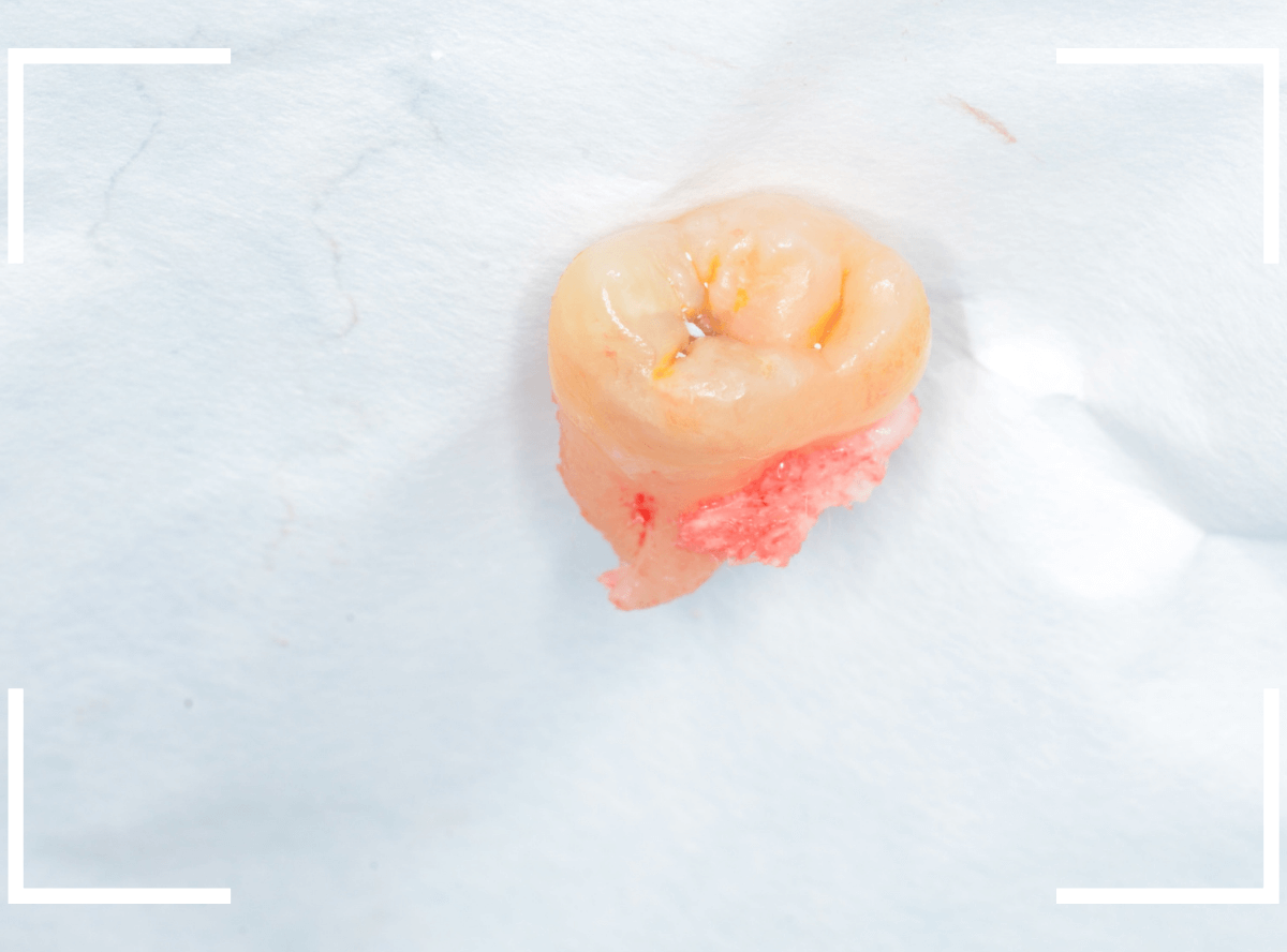 おやしらずの抜歯9-3