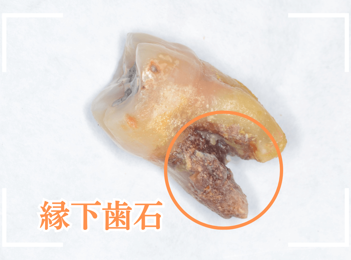 歯周病が原因で、抜歯2-3