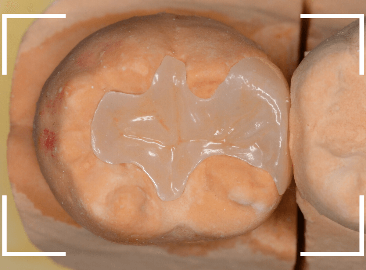 セラミック治療(インレー)16-3