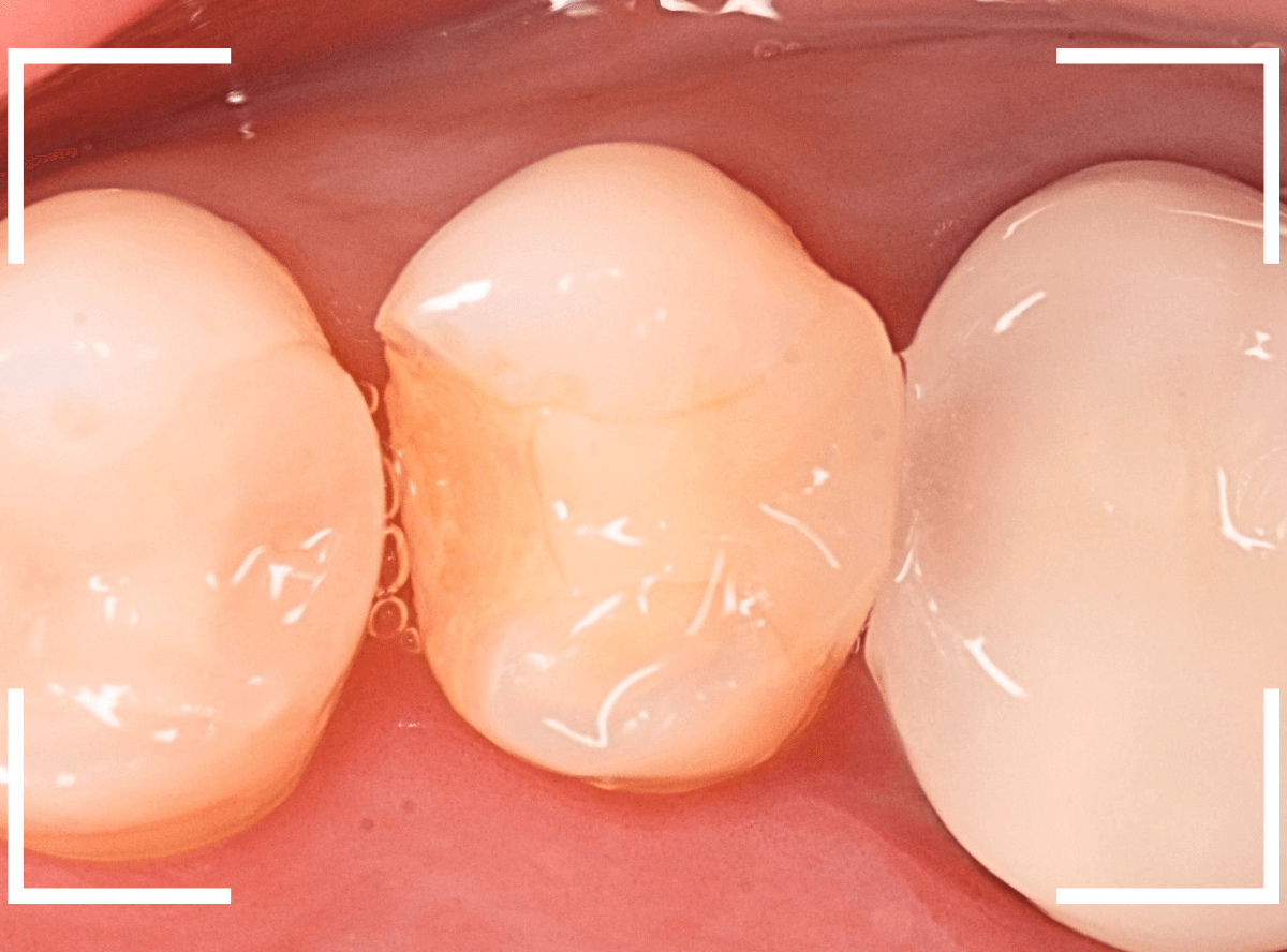 セラミック治療(インレー)22-1