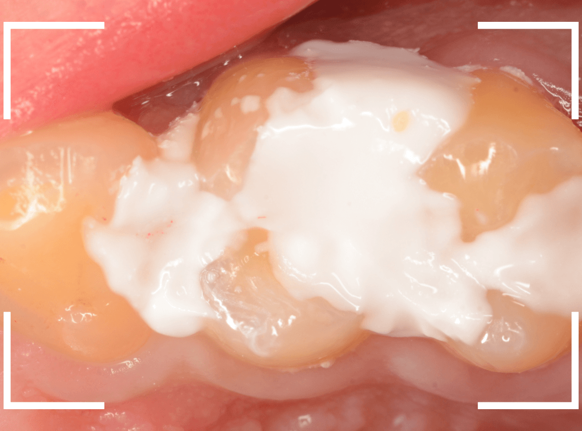 歯と歯の間の虫歯19-6