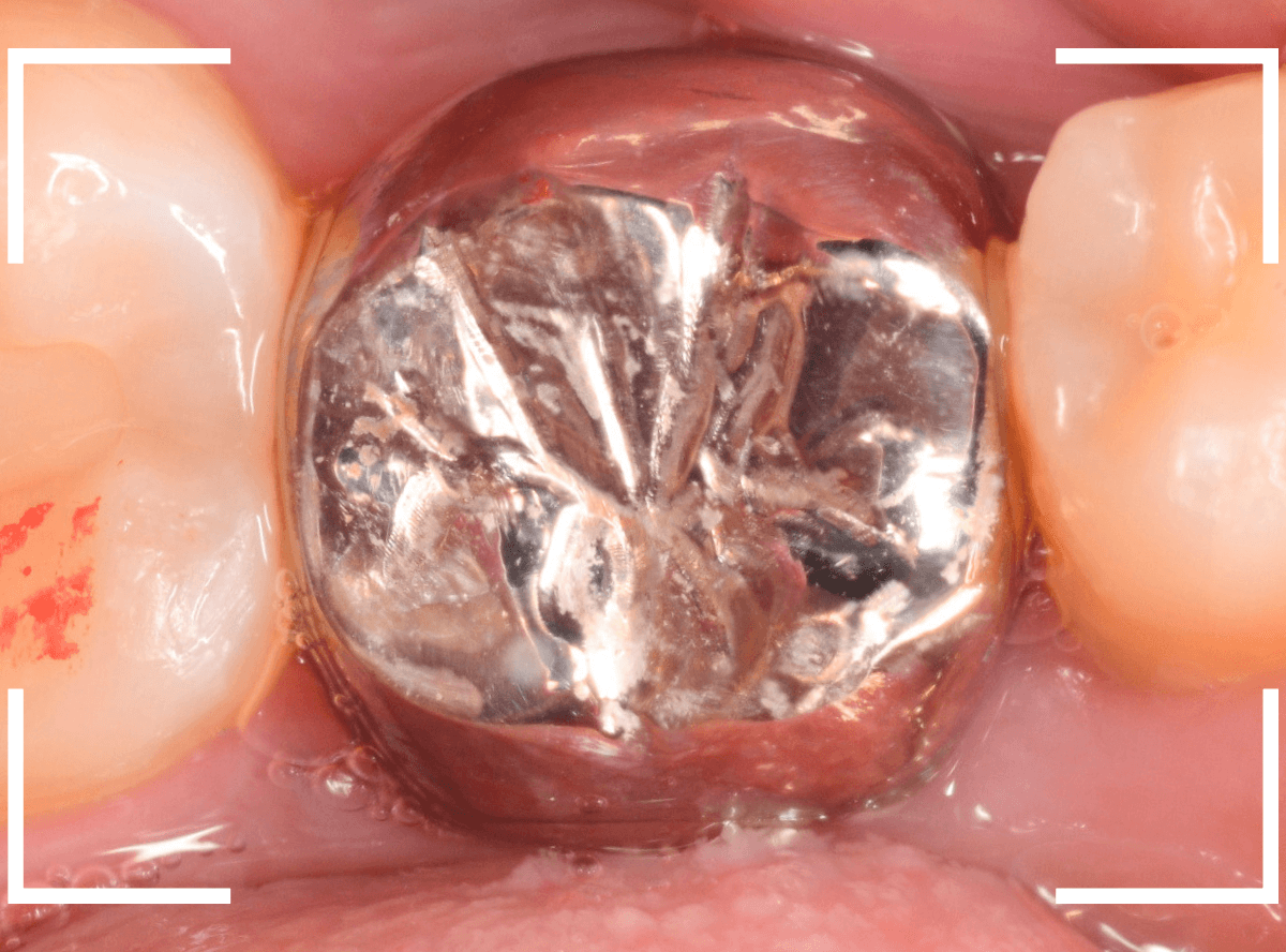 歯の土台の再治療1-5