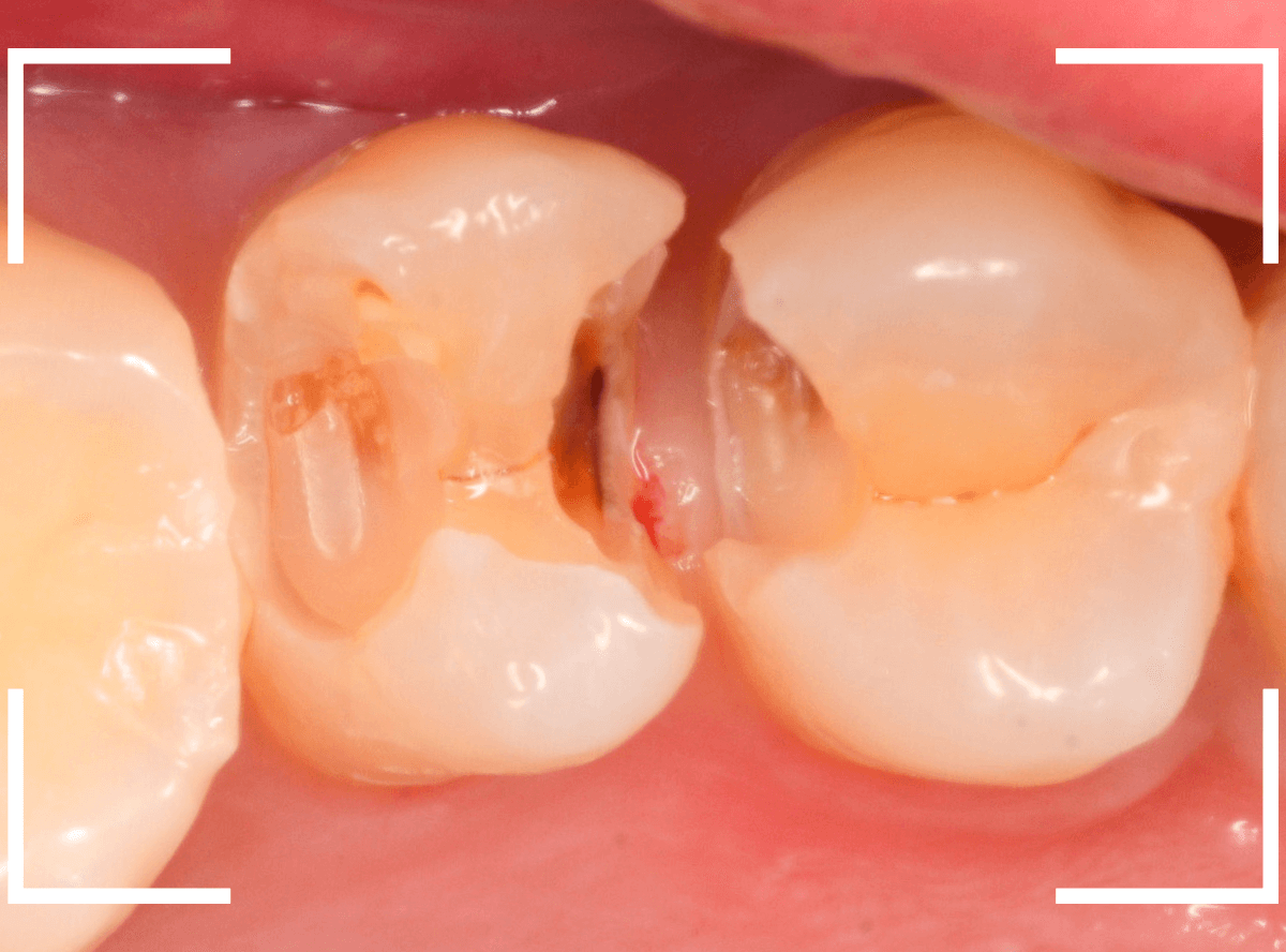 気づかないうちに深い虫歯8-3
