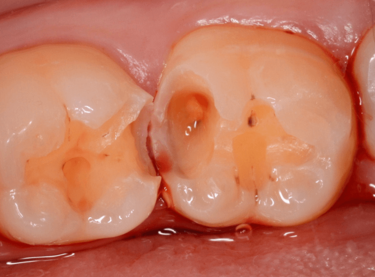 レントゲンでわかりづらい虫歯3-5