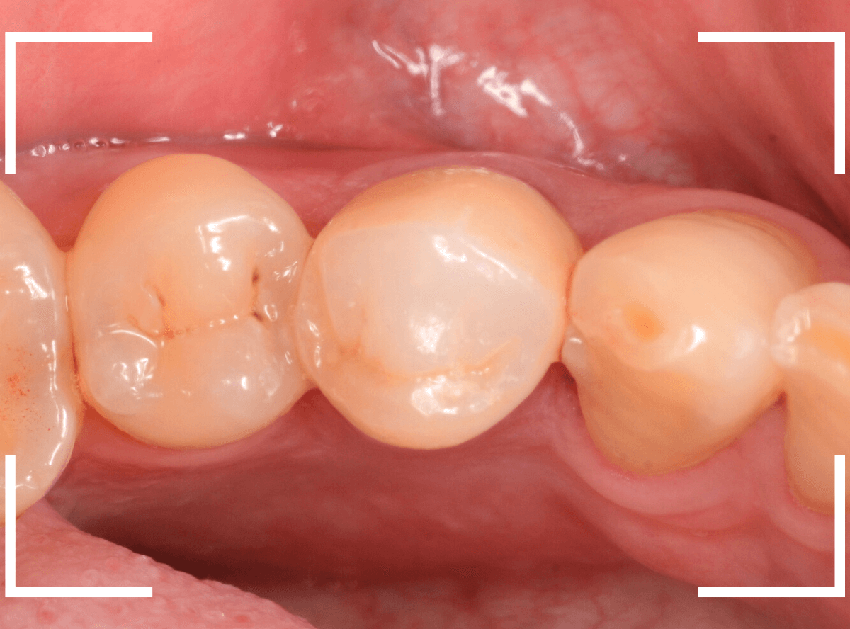セラミック治療(クラウン・奥歯)11-4