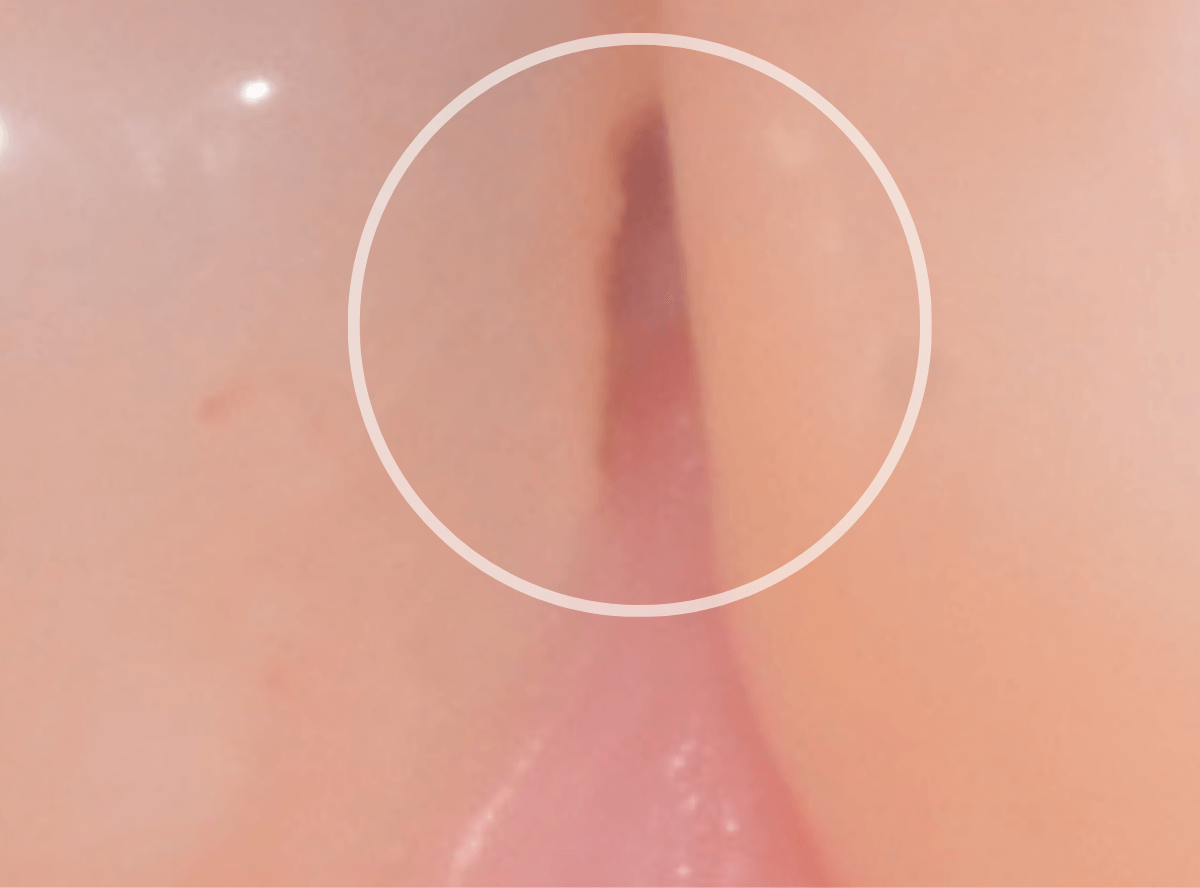 レントゲンでわかりづらい虫歯2-2