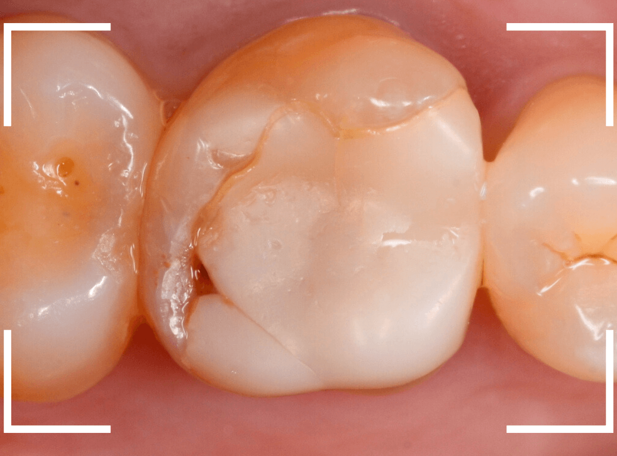 セラミック治療(インレー)19-1