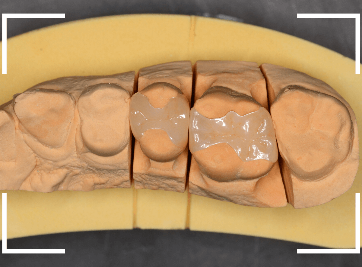 セラミック治療(インレー)24-9
