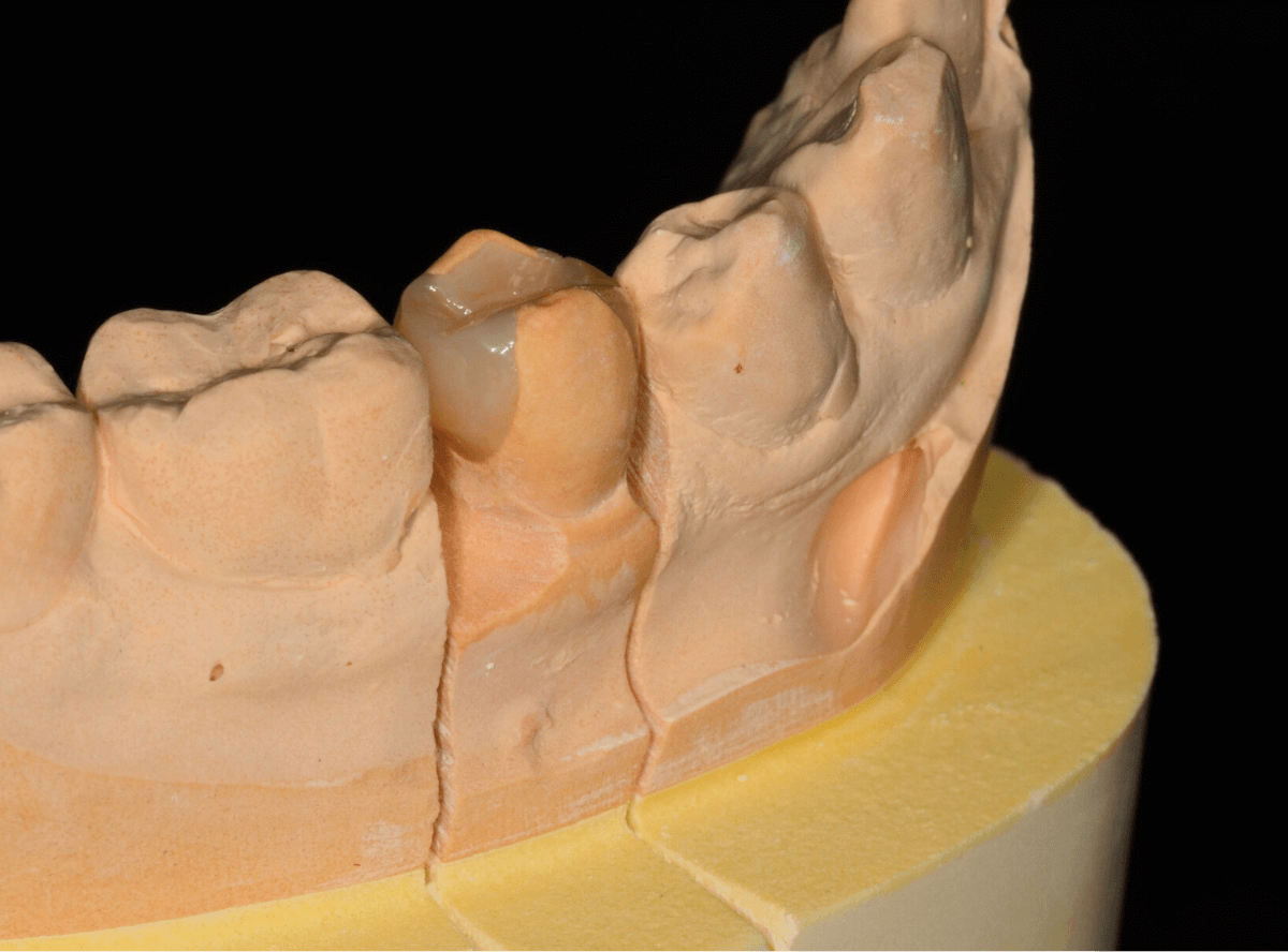 セラミック治療(インレー)5-2