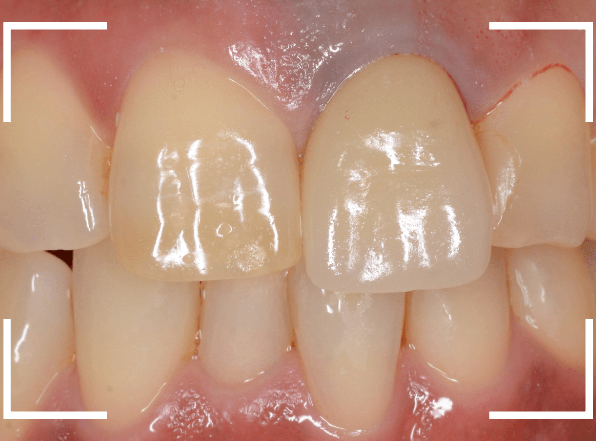 セラミック治療(前歯・クラウン)3-8