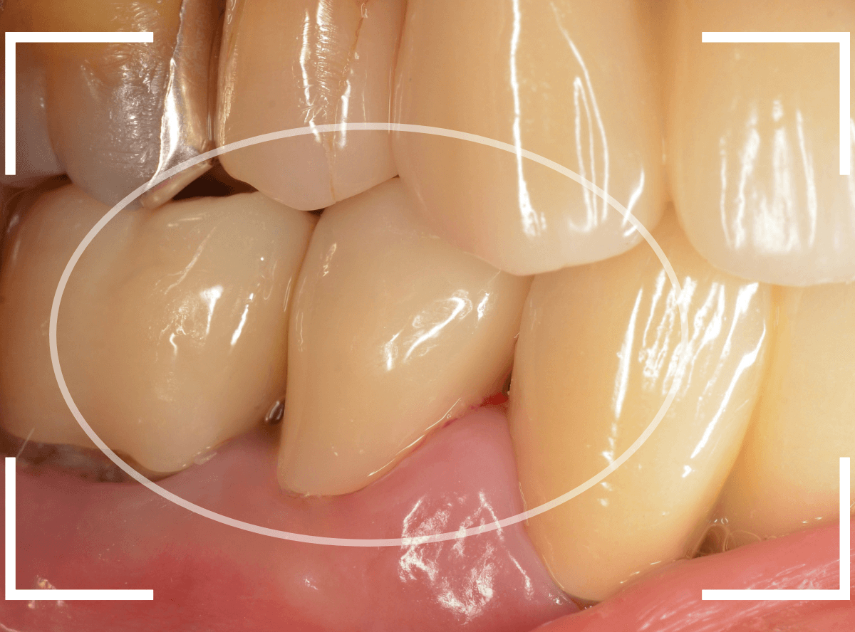 セラミック治療(クラウン・奥歯)8-6