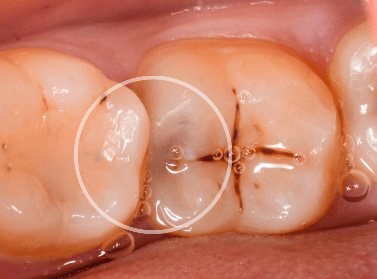 レントゲンでわかりづらい虫歯3-1