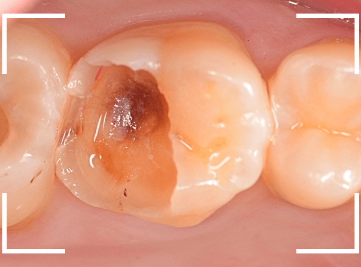 つめものの下の深い深い虫歯20-1