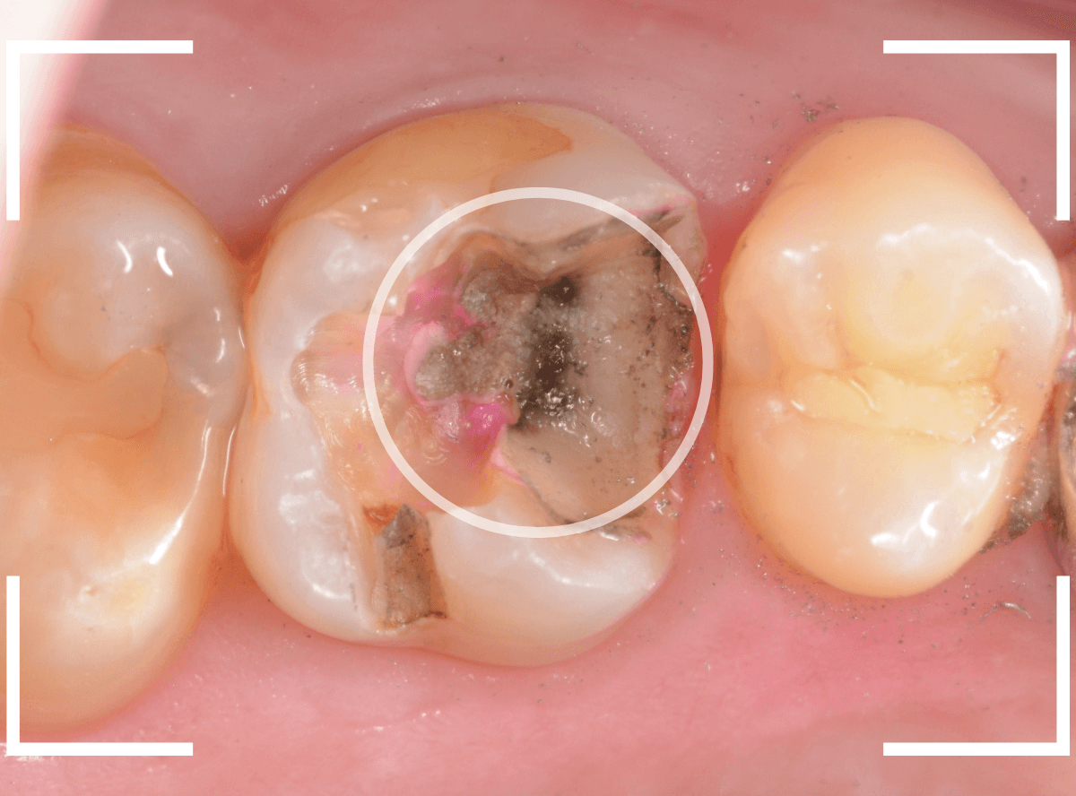 つめものの下の深い虫歯(画像)10-1