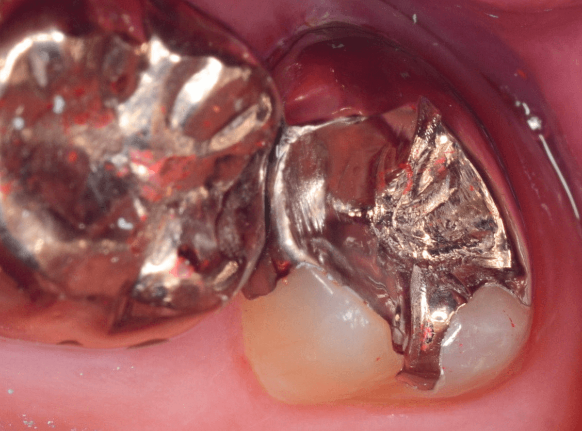 気づかないうちに深い虫歯2-4