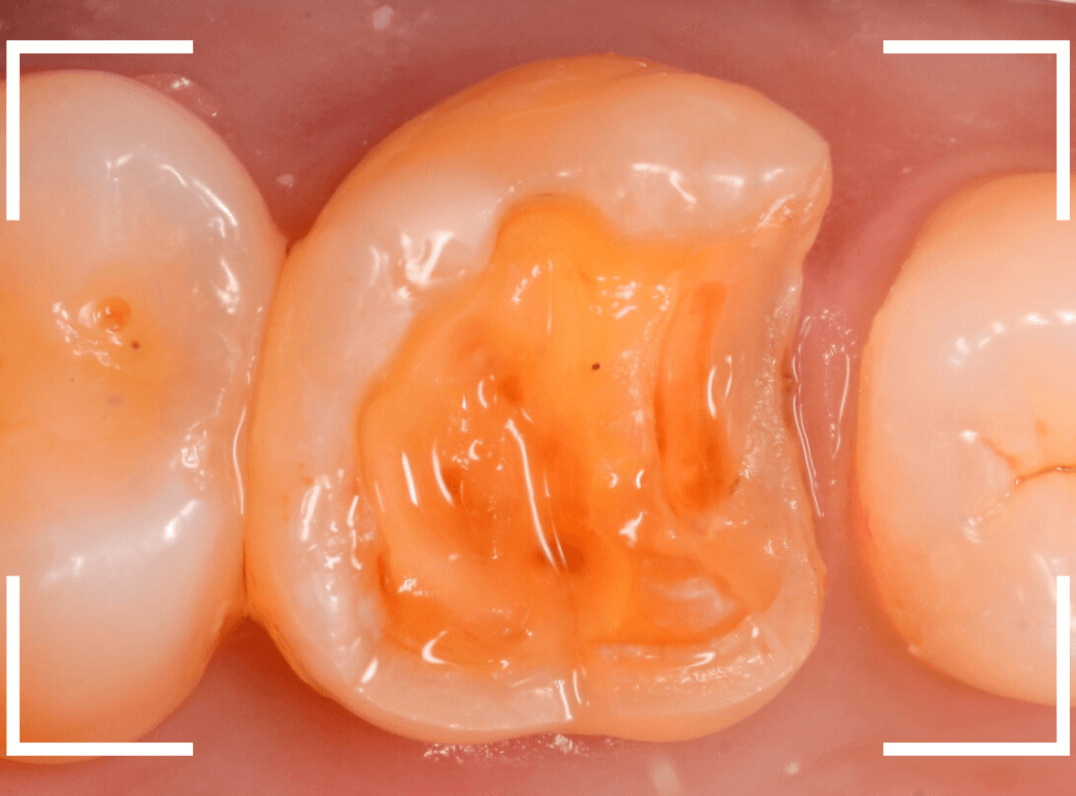 セラミック治療(インレー)19-3