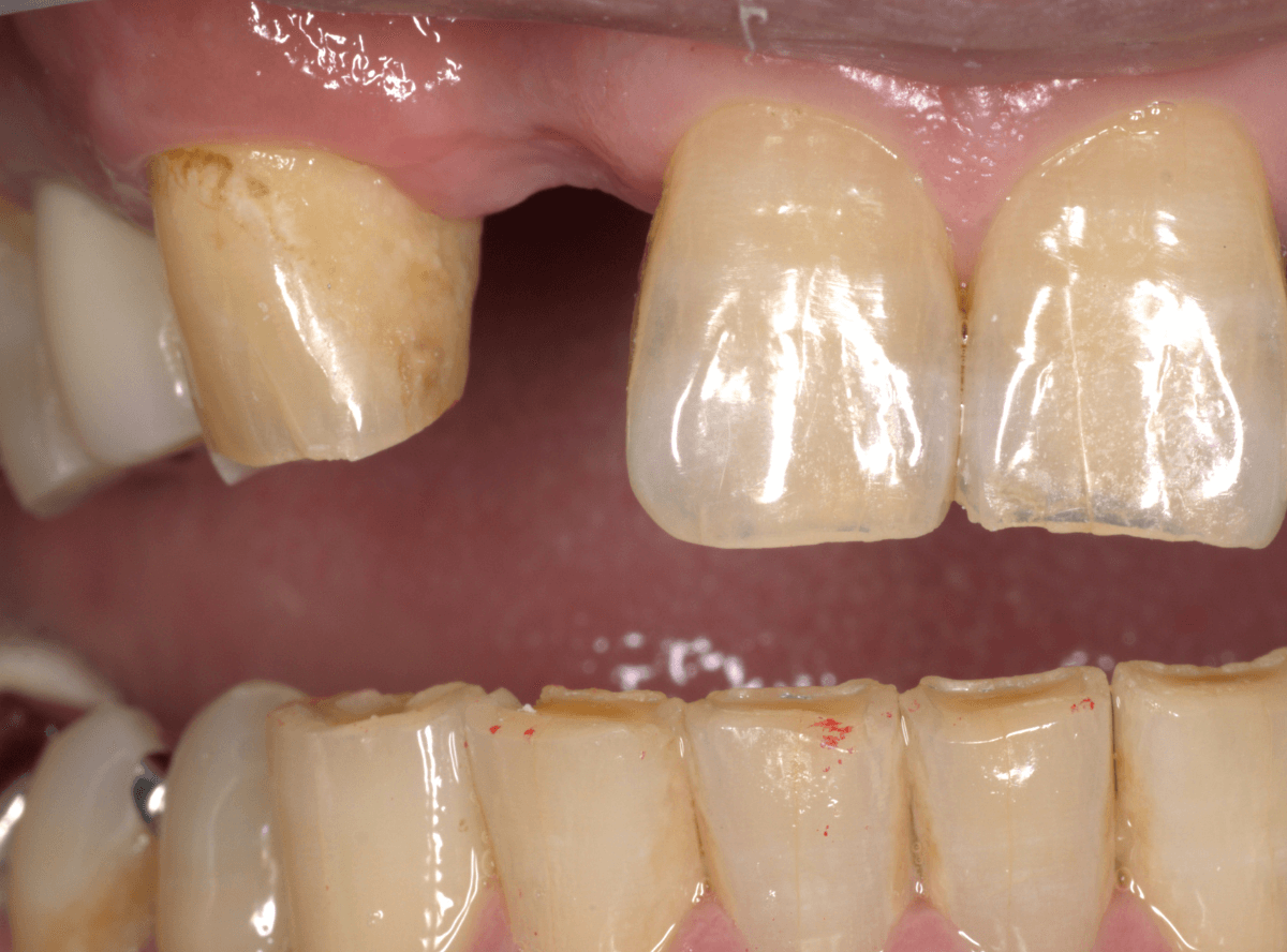 ノンクラスプ・デンチャー画像-1